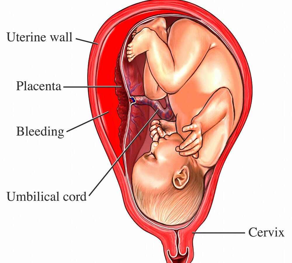 关于胎盘低置引产，六个月孕妇的指南